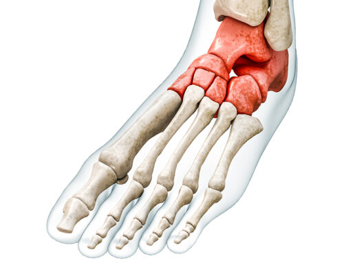 What Is Life Like After an Ankle Fusion?
