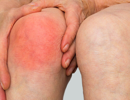 Rheumatoid Arthritis Knee Pain