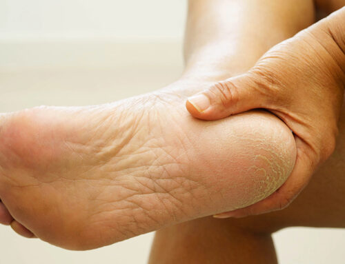 What Can I Do to Help My Osteoarthritis of the Ankle?